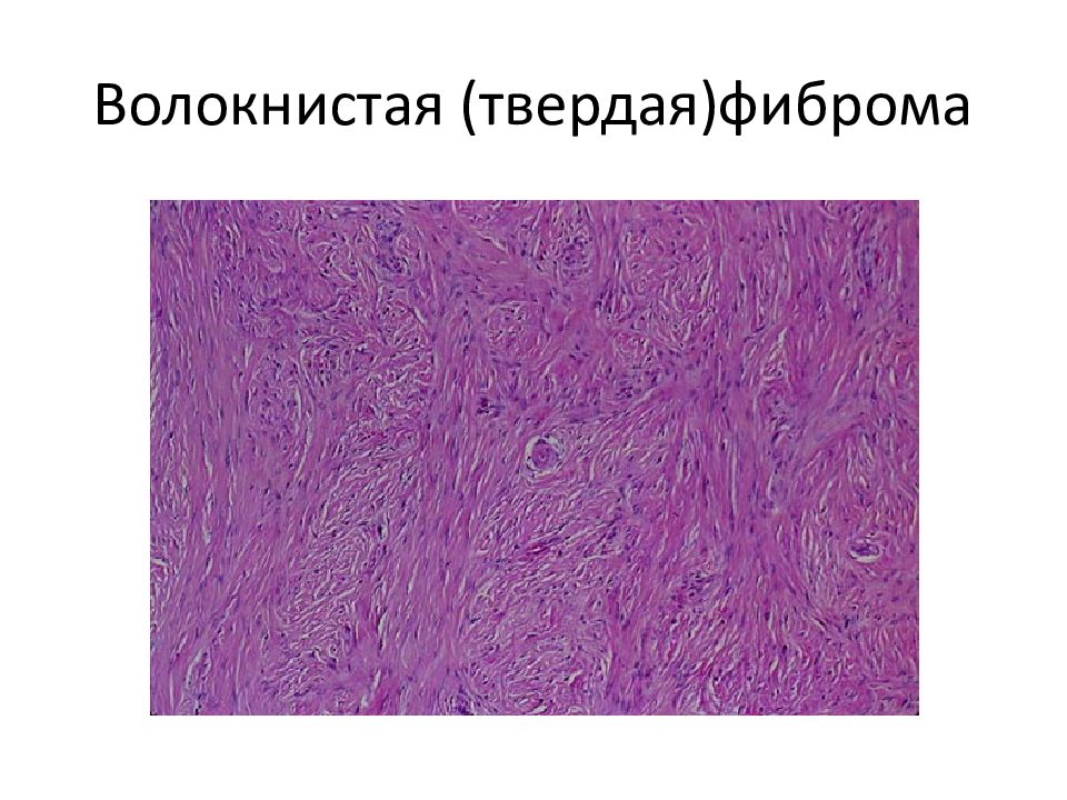 Фиброма пищевода микропрепарат рисунок