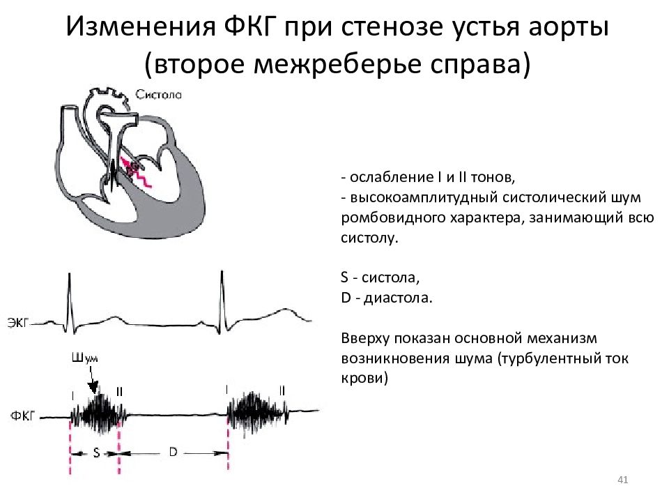 Аускультативная картина при митральном стенозе сердца включает