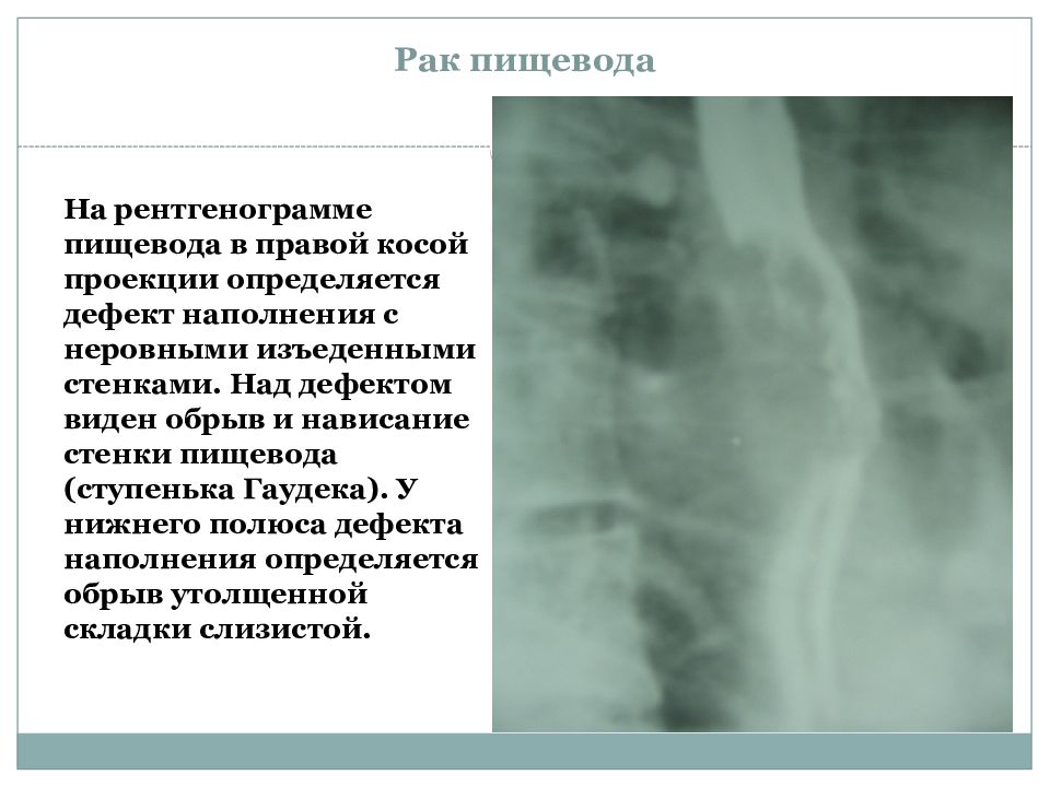 Рентгенография пищевода. Дефект наполнения пищевода. Дефект наполнения пищевода при рентгенографии. Правая косая проекция пищевода. Пищевод в правой косой проекции.