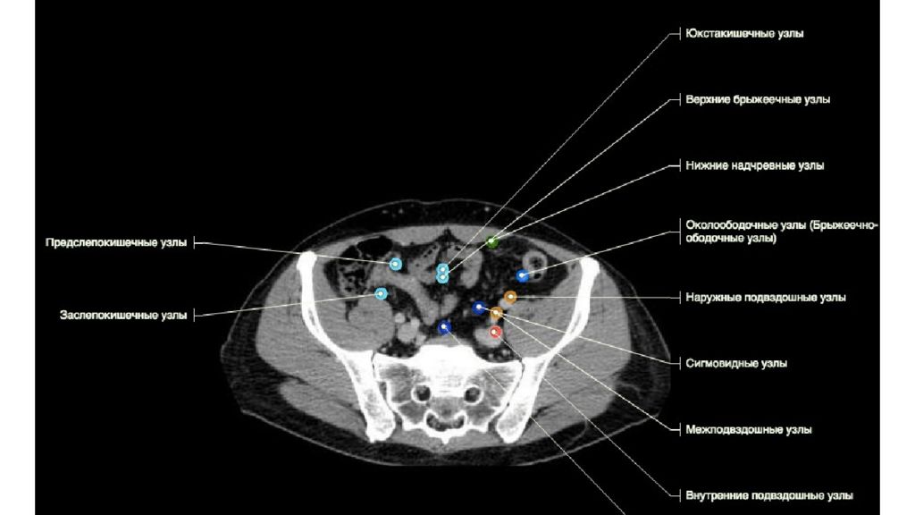 Забрюшинные лимфатические узлы. Лимфатические узлы брюшной полости кт анатомия. Лимфоузлы брюшной полости на кт анатомия. Лимфатические узлы брюшной полости кт. Группы лимфатических узлов брюшной полости кт.