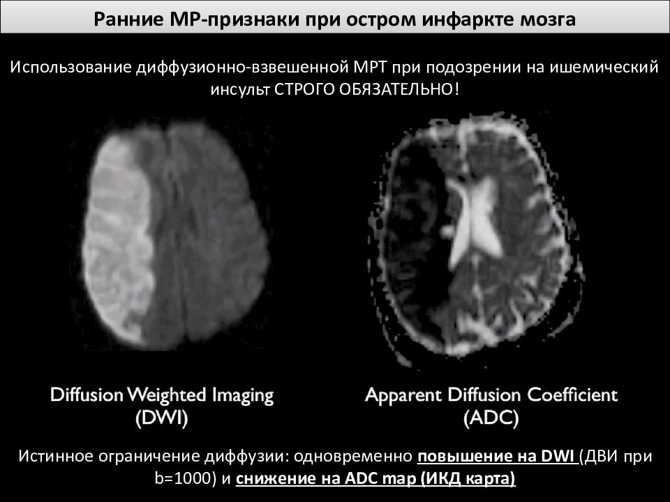 Диффузионно взвешенное изображение