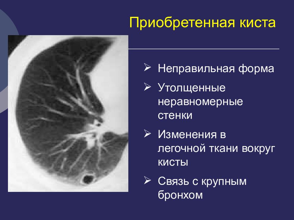 Кисты легких у детей презентация