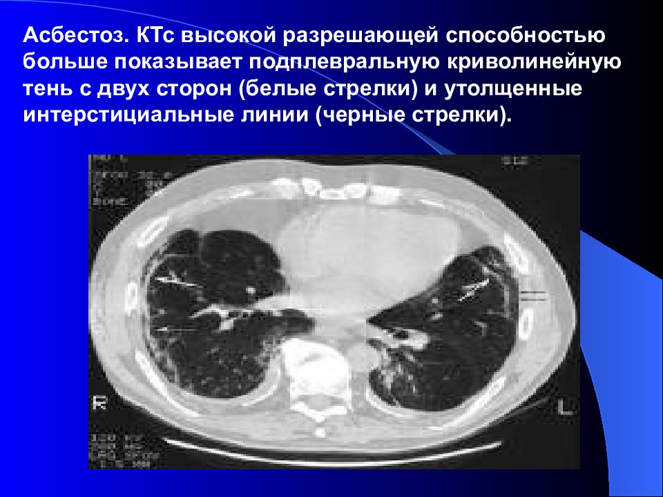 Асбестоз это. Асбестоз. Асбестоз кт. Асбестоз рентген.