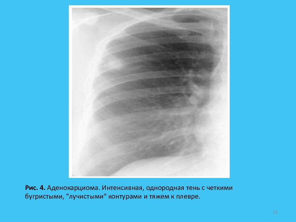 Тени средней интенсивности в легком