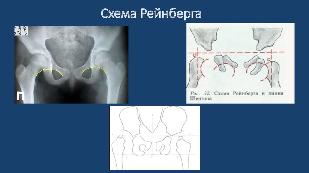 Схема рейнберга врожденный вывих бедра