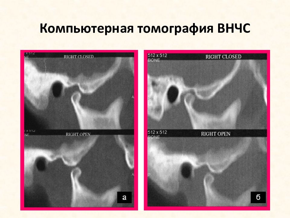 Презентация мрт внчс