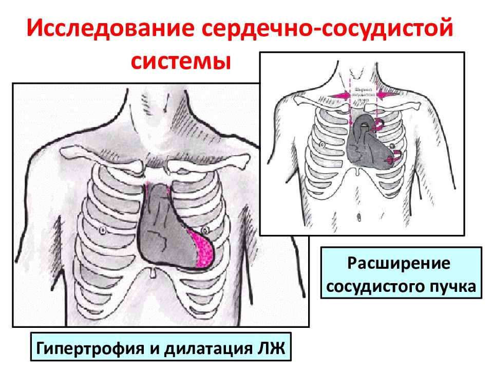 Сосудистый пучок. Расширение границ сосудистого пучка. Сердечно сосудистый пучок. Расширение сосудистого пучка вправо. Сосудистый пучок расширен.