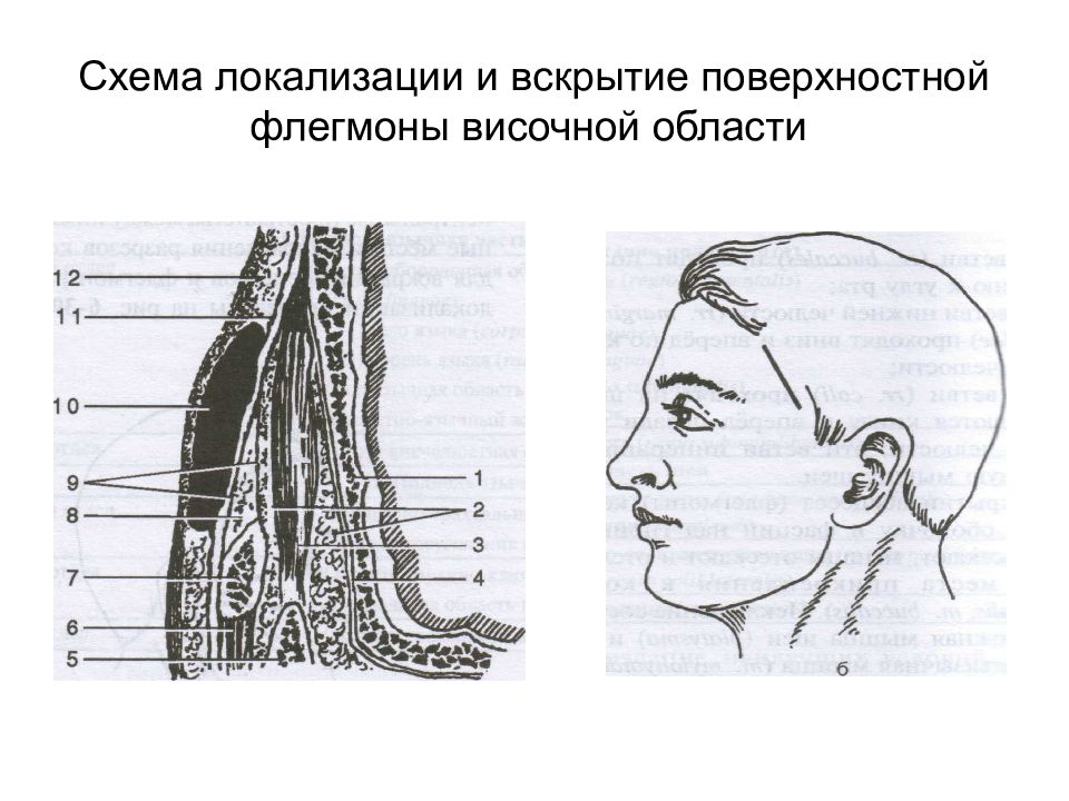 Вскрытие подапоневротической флегмоны