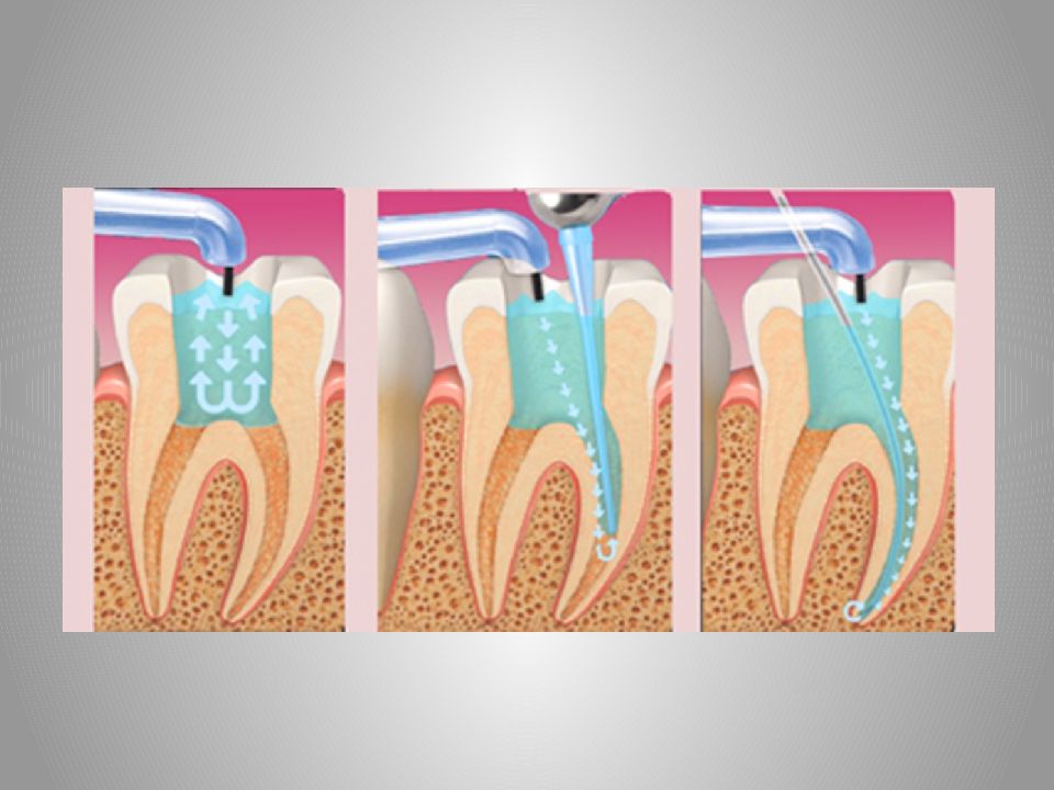 Ирригация корневых каналов презентация
