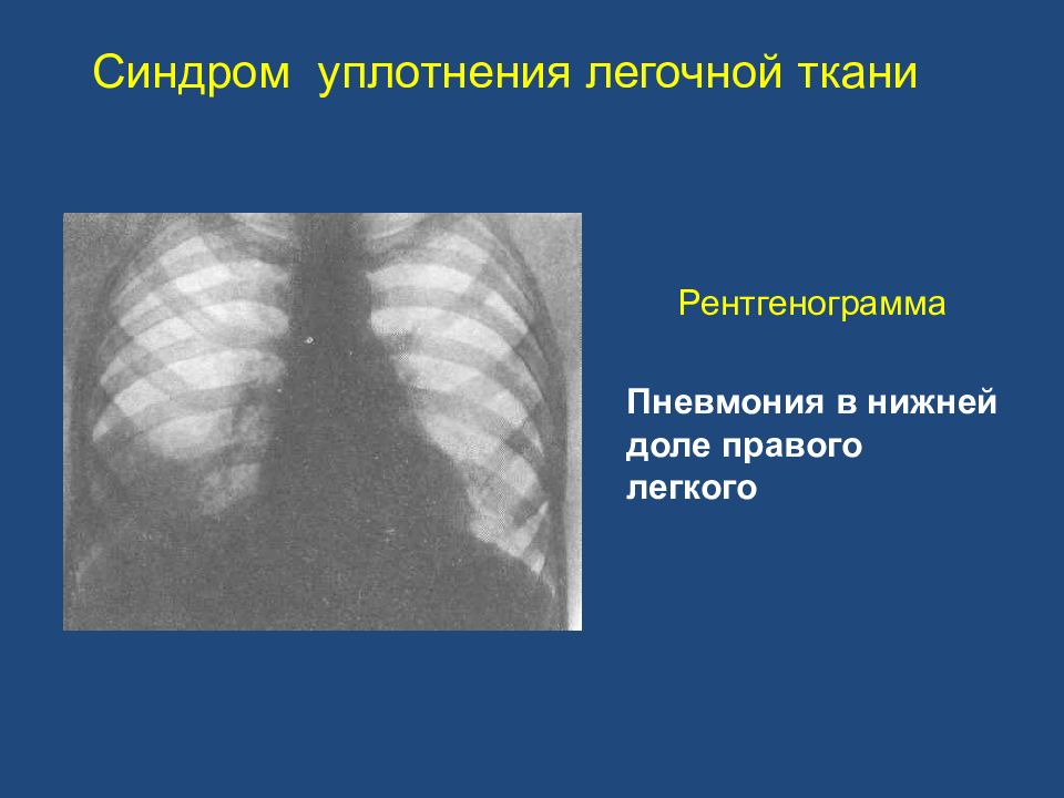 Пневмония в правом легком в нижней доле. Синдром долевого уплотнения легочной ткани рентген. Синдром долевого уплотнения легочной ткани. Синдром очагового уплотнения легочной ткани рентген. Синдром очагового уплотнения легочной ткани пропедевтика.