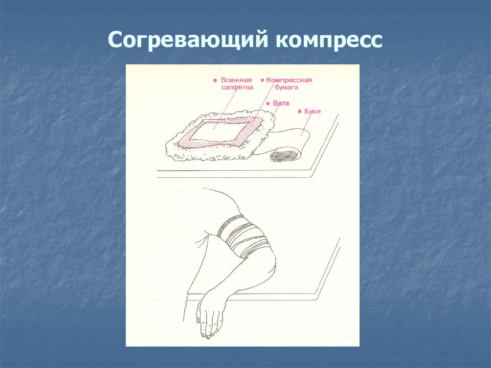 Количество слоев у согревающего компресса. Согревающий компресс. Техника постановки согревающего компресса. Схема постановки согревающего компресса. Постановка согреыающегл компресс.