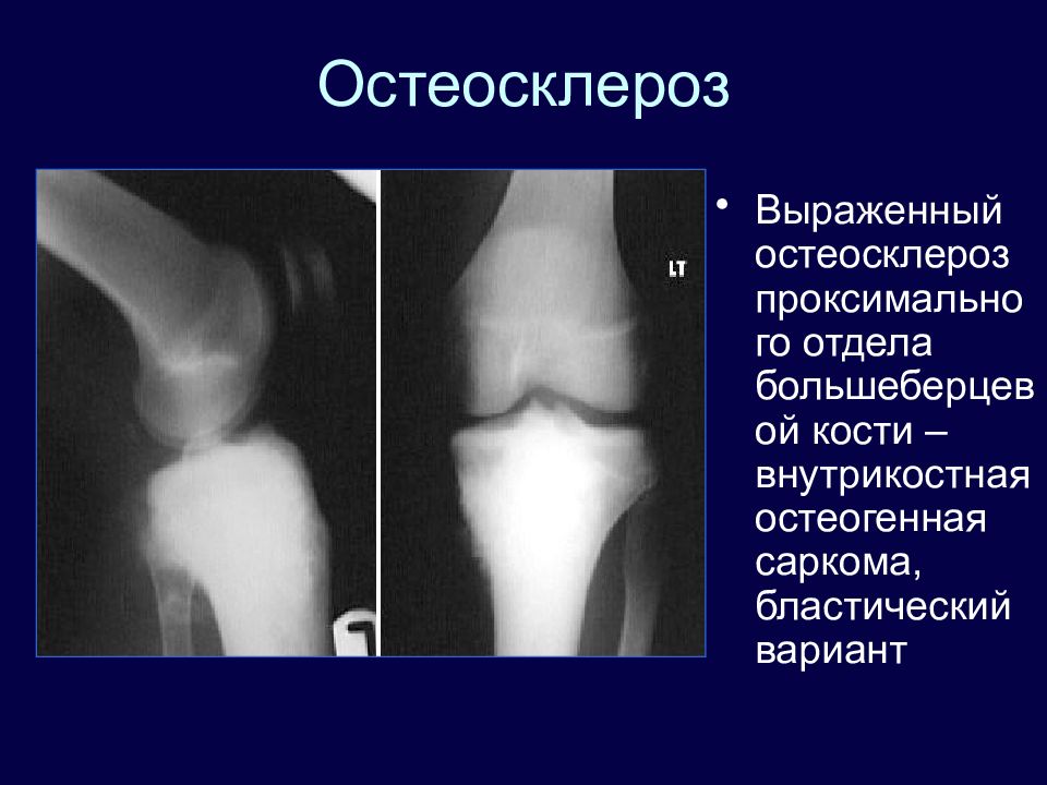 Клиническая картина при остеогенной саркоме в начале заболевания выражается следующими признаками