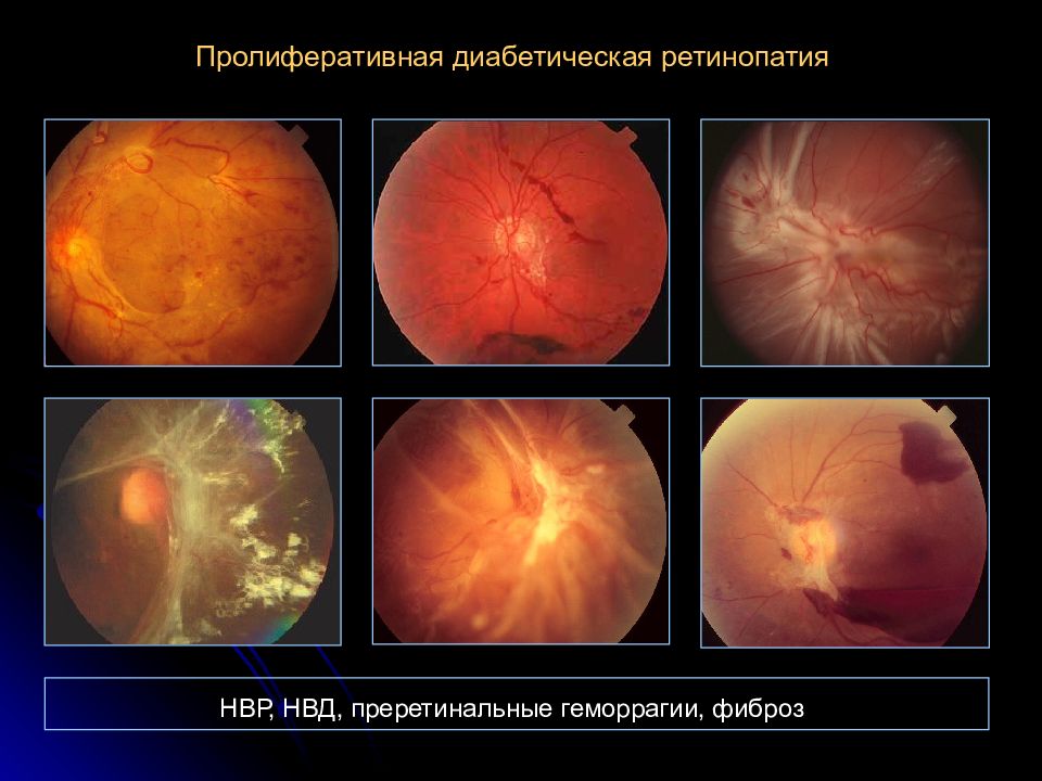 Диабетическая ретинопатия. Препролиферативная диабетическая ретинопатия. Пролиферативная и непролиферативная ретинопатия. Диабетическая ретинопатия пролиферативная стадия. Пролиферативная стадия диабетической ретинопатии клиника.