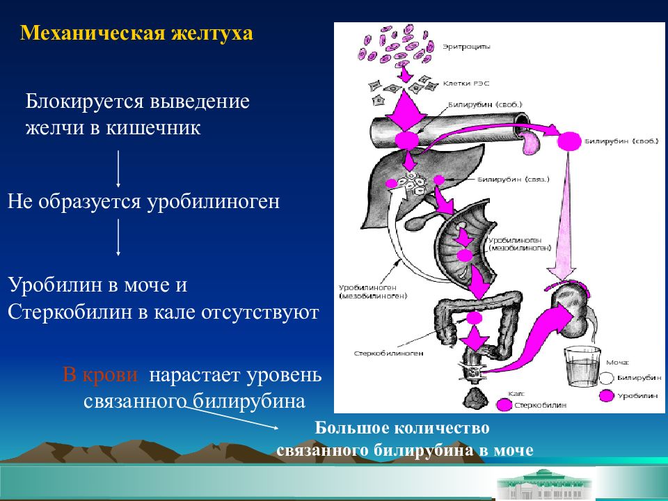 Подпеченочная желтуха схема