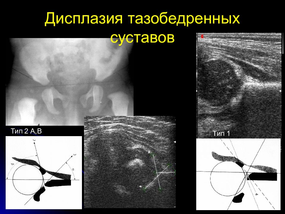 Узи тазобедренного. Дисплазия тазобедренных суставов у детей УЗИ. Дисплазия тазобедренных суставов у новорожденных УЗИ. УЗИ тазобедренный сустав Тип 2. Дисплазия тазобедренного сустава 2 а.