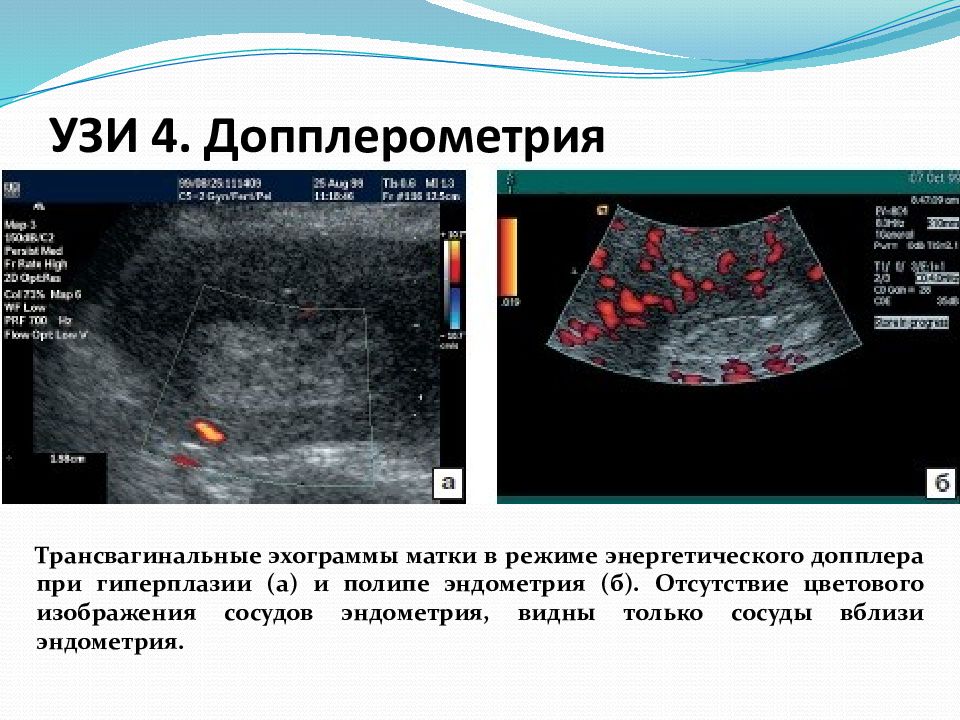 Гиперплазия полости матки. Допплерометрия сосудов эндометрия. Гиперпластические процессы эндометрия УЗИ. Ультразвуковые критерии гиперплазии эндометрия. Гиперплазия эндометрия УЗИ критерии.
