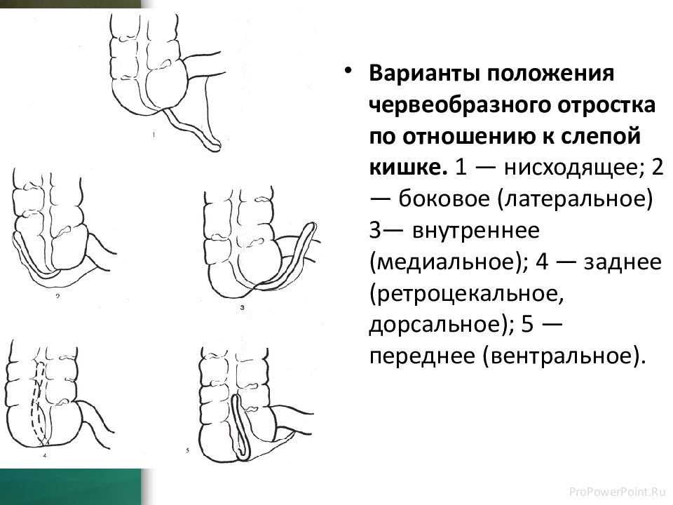 Аппендэктомия — презентация