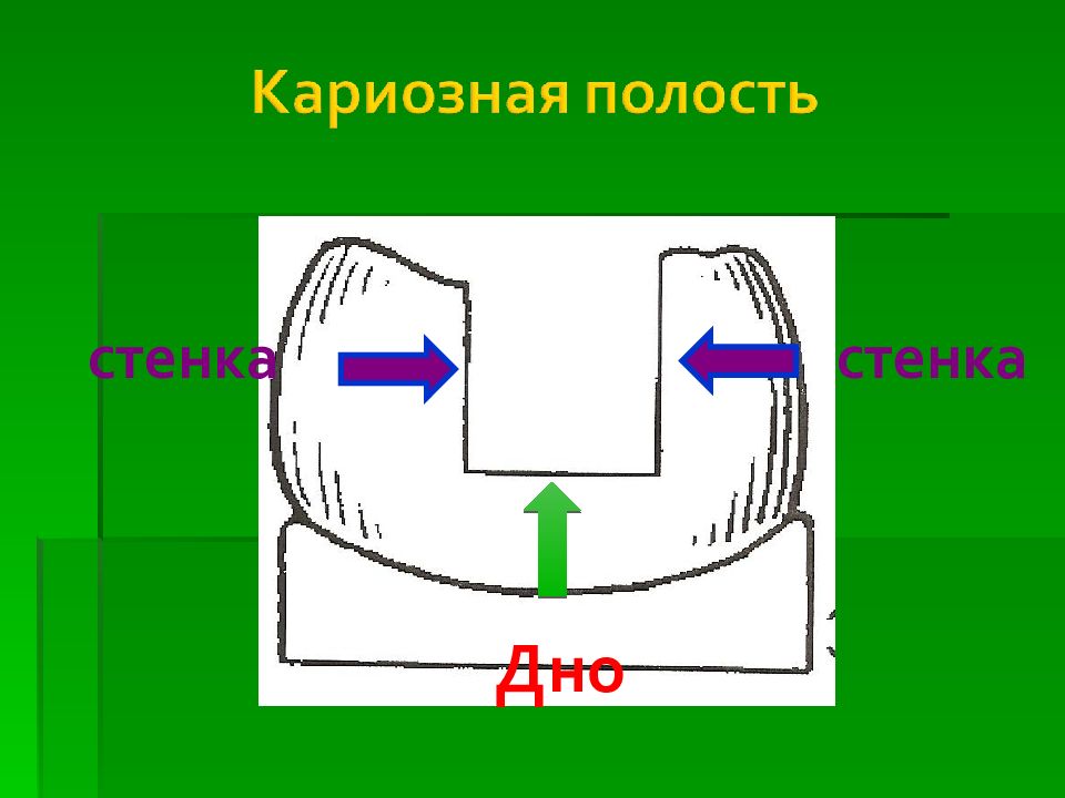 Стенка кариозной полости