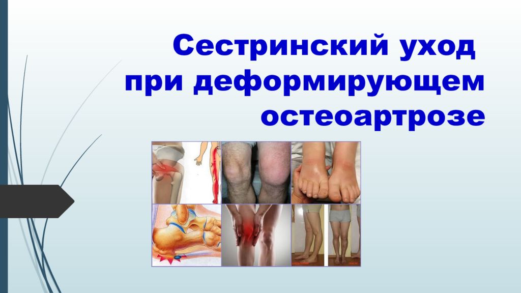 Сестринский уход при деформирующем остеоартрозе