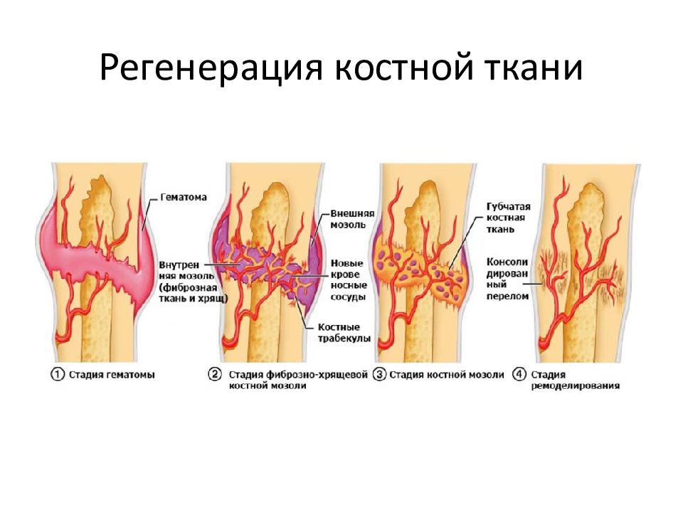 После эти этапы. Схема регенерации костной ткани после перелома. Регенерация костной ткани при переломах гистология. Регенерация костной ткани при переломах этапы. Стадии регенерации костной ткани.