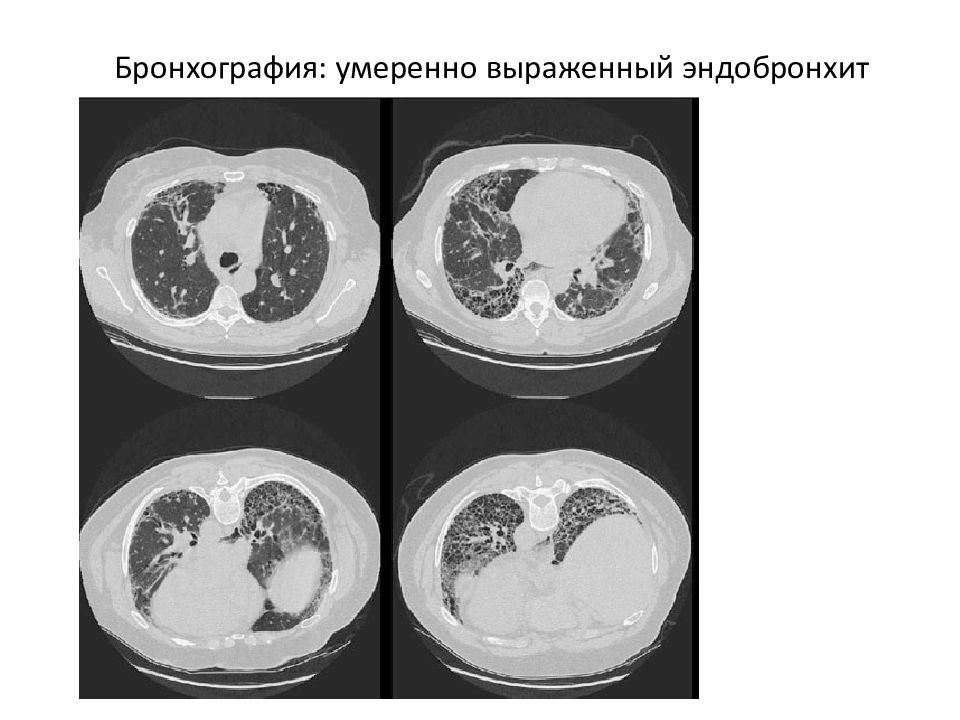 Диффузный катаральный эндобронхит. Диффузный эндобронхит бронхоскопия. Диффузный Гнойный эндобронхит.