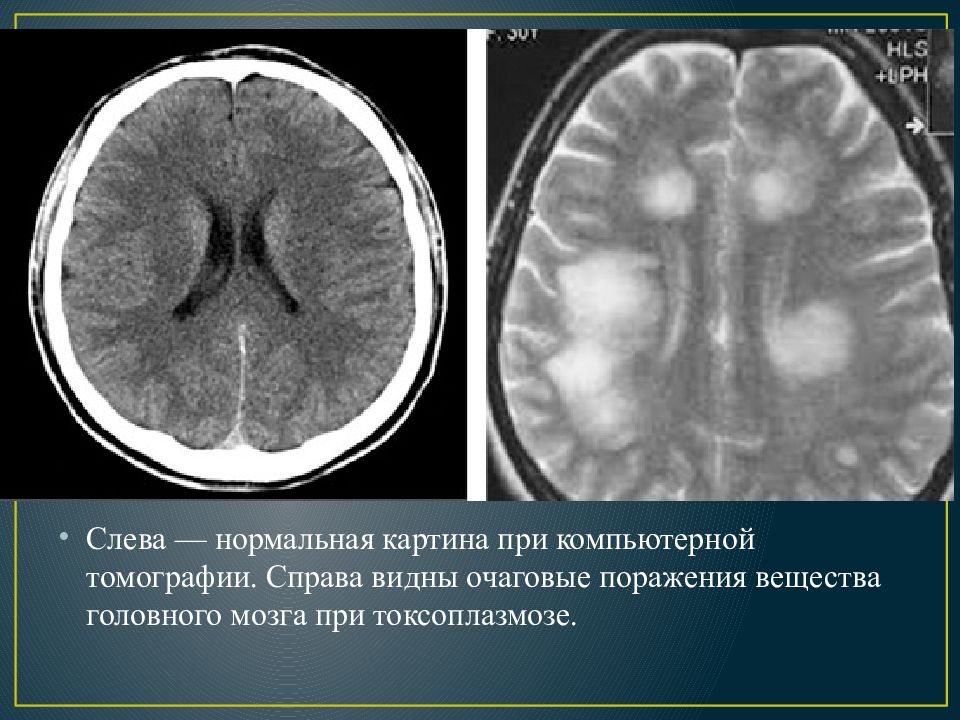 Энцефалит мрт картина