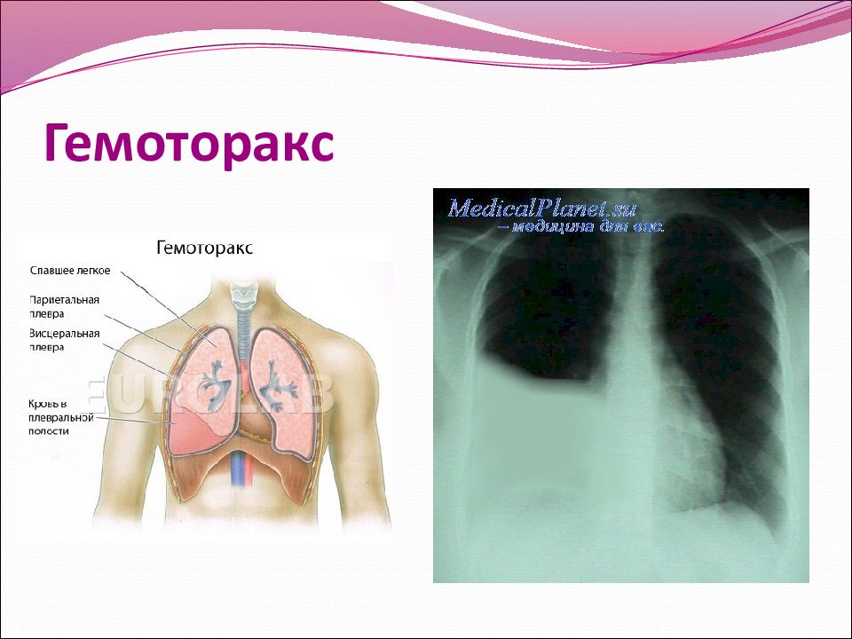 Презентация пневмоторакс и гемоторакс