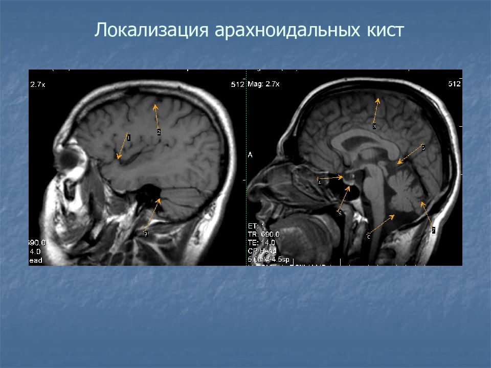 Картина изменений ликворокистозного характера