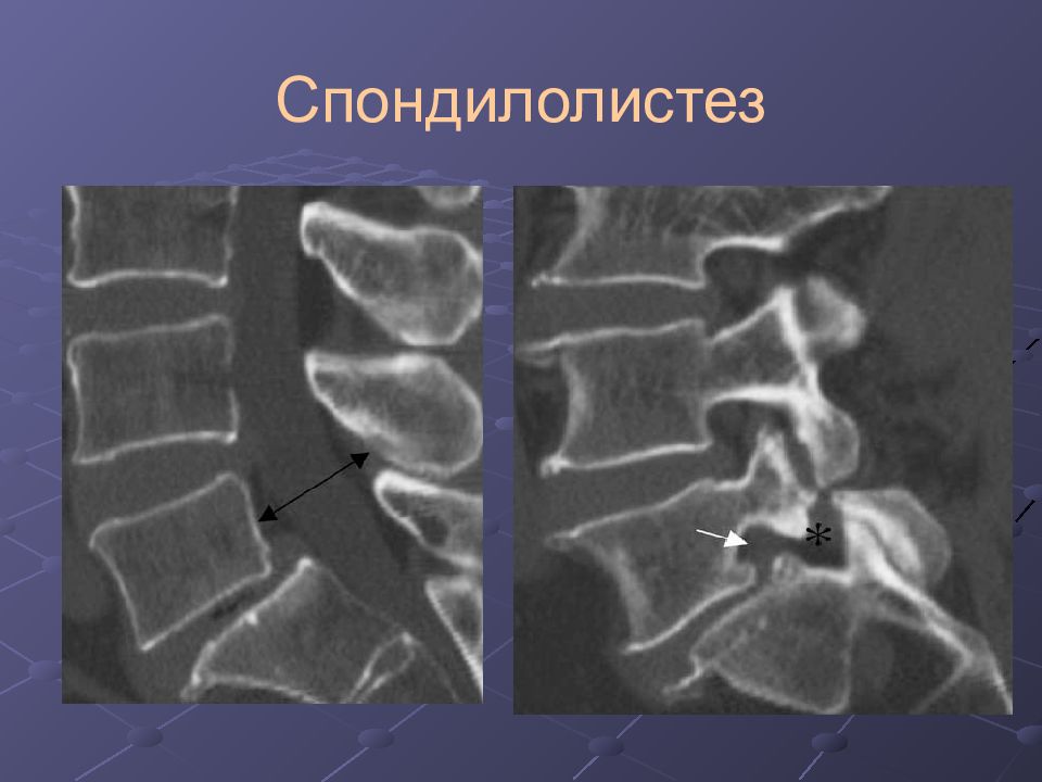 Антелистез позвонка. Спондилолистез l5 рентген. Спондилолиз l5. Спондилолизный спондилолистез l5 рентген. Спондилолиз l5 позвонка рентген.