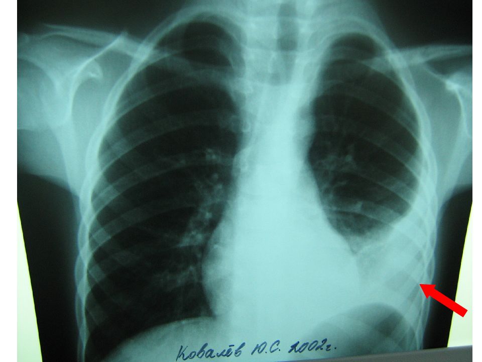 Прогрессирование туберкулеза. Внелегочный туберкулез рентген. Легочный и внелегочный туберкулез. Формы туберкулеза снимки. Внелегочные формы туберкулеза.