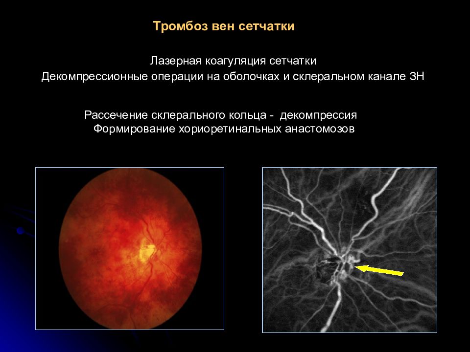 Окклюзия центральной артерии сетчатки. Тромбозы вен сетчатки презентация. Претромбоз венсетчатки.