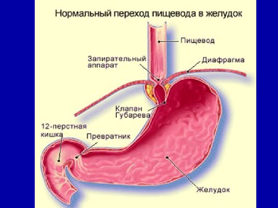 Рефлюкс эзофагит картинки