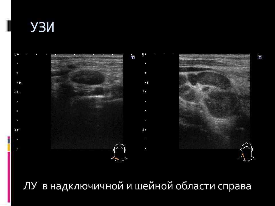 Узи периферических лимфоузлов