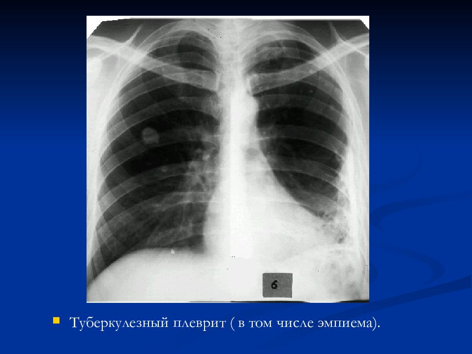 Схема развития туберкулезных плевритов