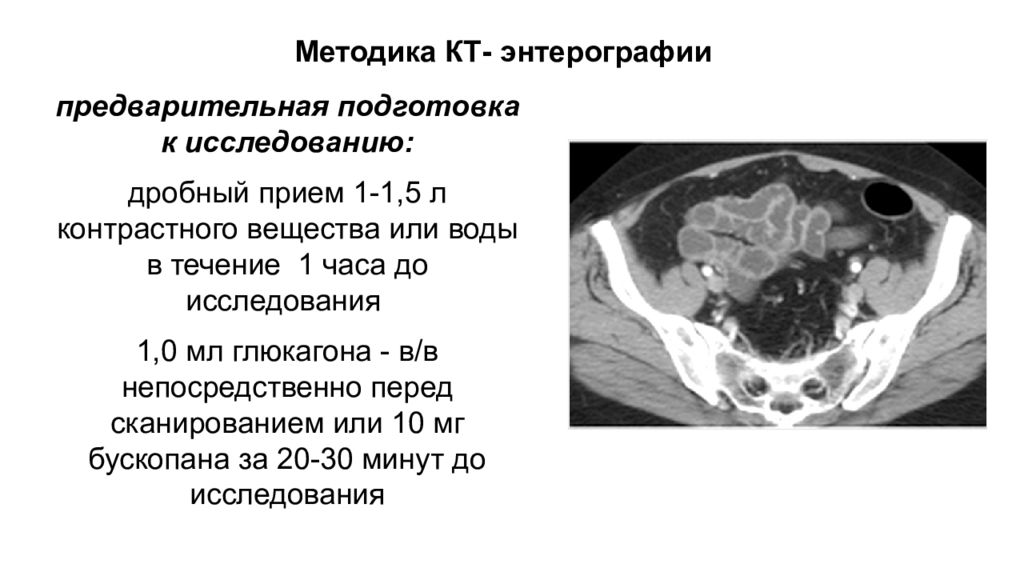 Энтерография. Кт энтерография тонкого кишечника. Энтерография методика. Кт-энтерография с контрастом. Кт брюшной полости энтерография подготовка.