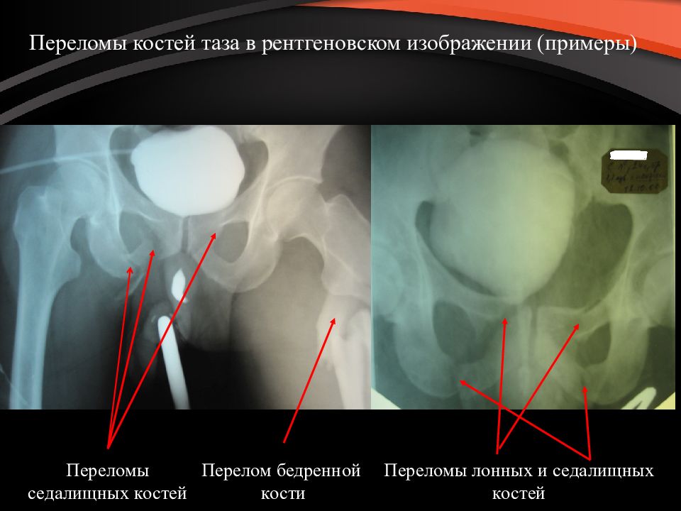 Презентация на тему перелом костей таза