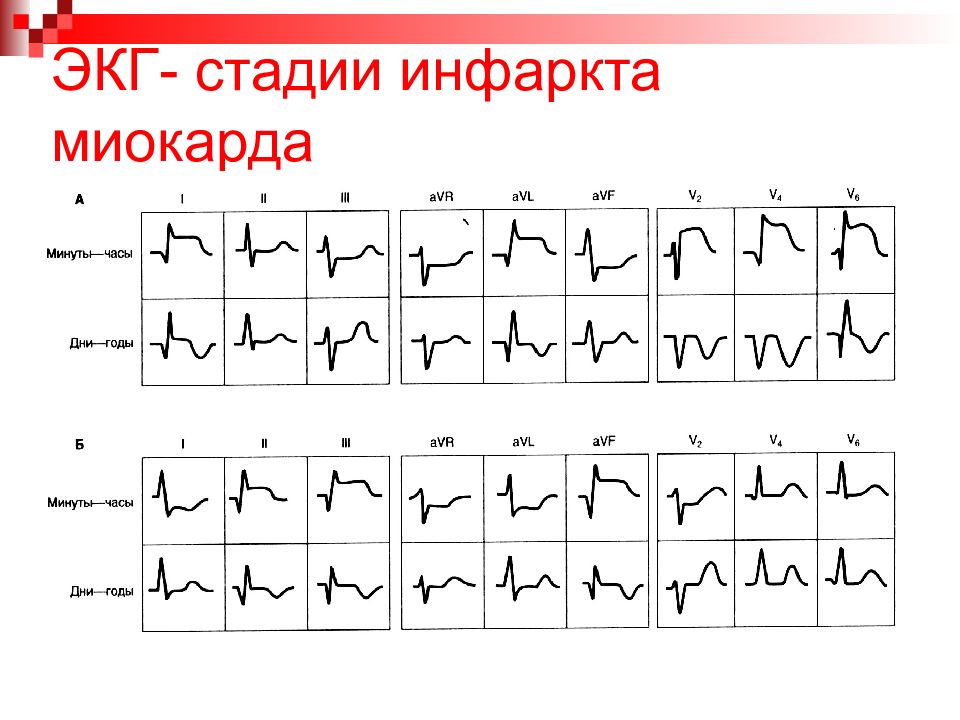 Инфаркт миокарда картинки экг