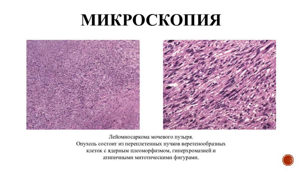 Мезенхимальные опухоли патанатомия презентация