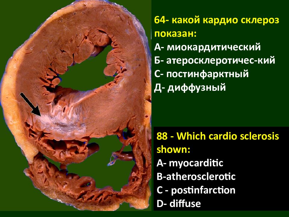 Кардиосклероз это. Постинфарктный склероз. Миокардитический склероз. Экзамен анатомия и патологическая. Постинфарктный склероз костей.