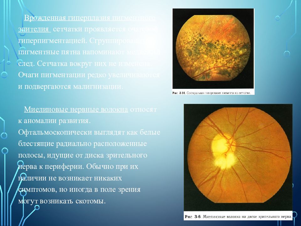 Пигментный ретинит презентация