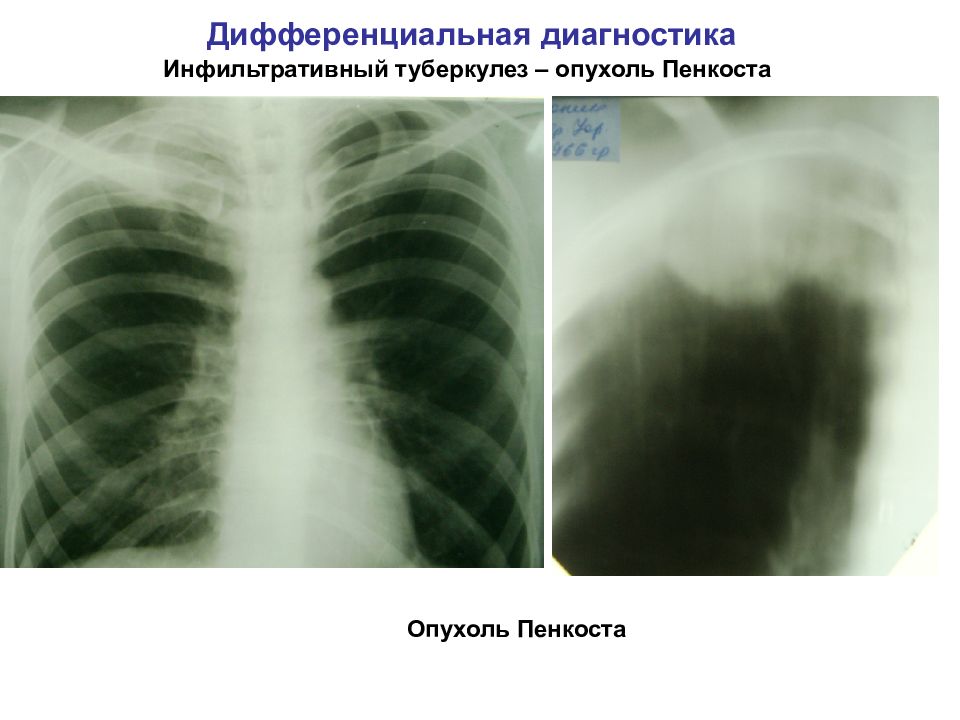 Инфильтративный туберкулез легких презентация