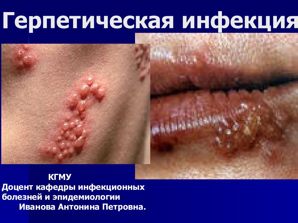 Герпетическая инфекция КГМУ Доцент кафедры инфекционных болезней и