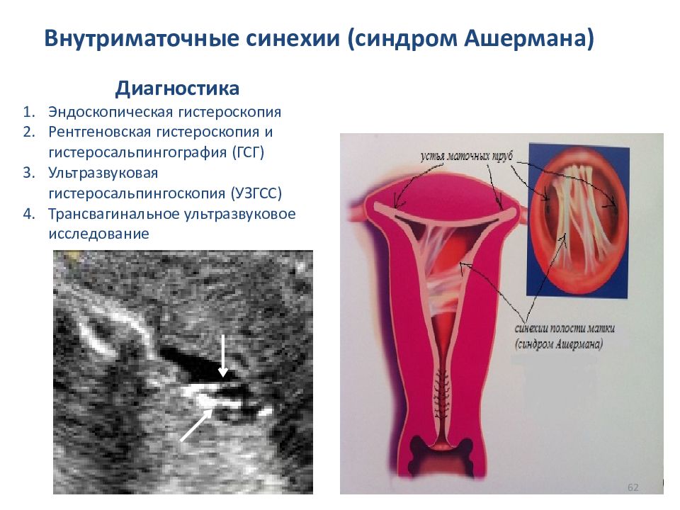 Спайки диагностика. Внутриматочные синехии. Внутриматочные синехии (синдром Ашермана).