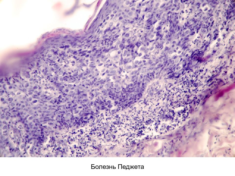 Болезнь педжета. Болезнь Педжета кости гистология. Опухоль Педжета гистология. Болезнь Педжета микропрепарат. Педжета молочной железы.