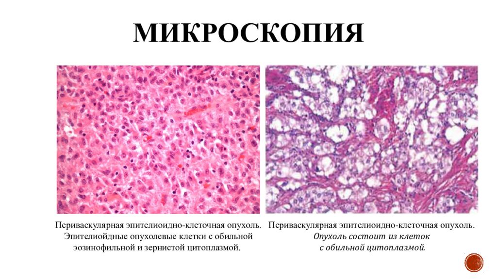 Мезенхимальные опухоли. Мезенхимальные опухоли микропрепараты. Злокачественная зернистоклеточная опухоль. Зернистоклеточная опухоль Абрикосова микропрепарат. Опухоль Абрикосова гистология.