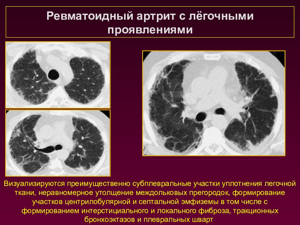 Субплевральный узелок. Уплотнение легочной ткани на кт. Центрилобулярная эмфизема на кт. Эмфизема кт. Утолщение междолькового интерстиция на кт.