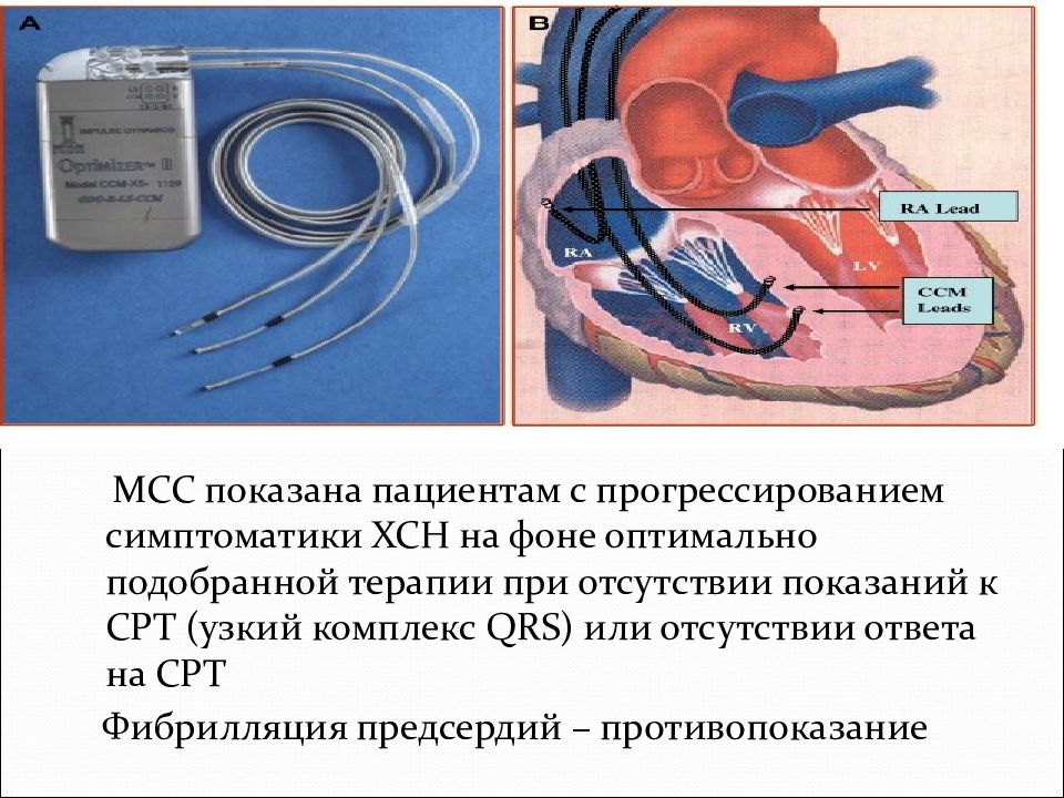 Ресинхронизирующая терапия презентация