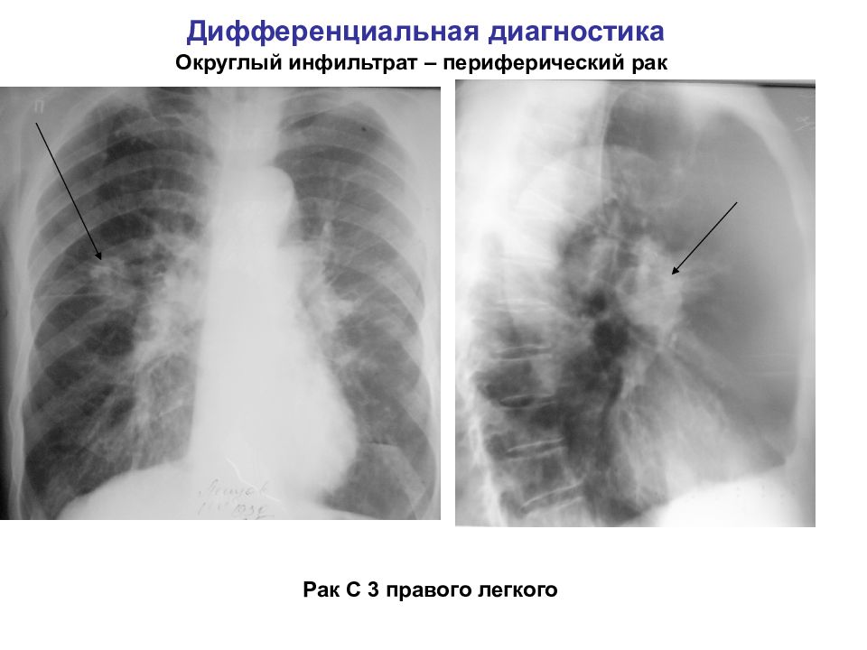Дифференциальная диагностика при легочном инфильтрате презентация