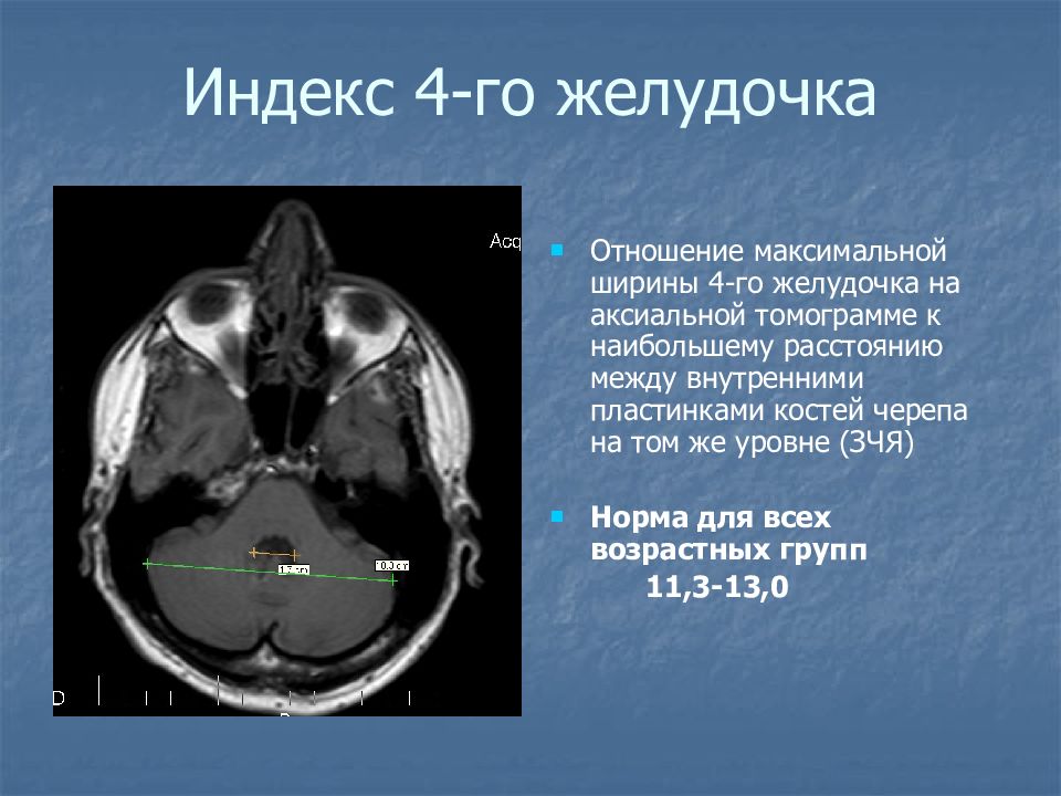 Расширения передних рогов. 4 Желудочек головного мозга кт. Размер 4 желудочка головного мозга. 4 Желудочек головного мозга анатомия мрт. Желудочки головного мозга кт анатомия.