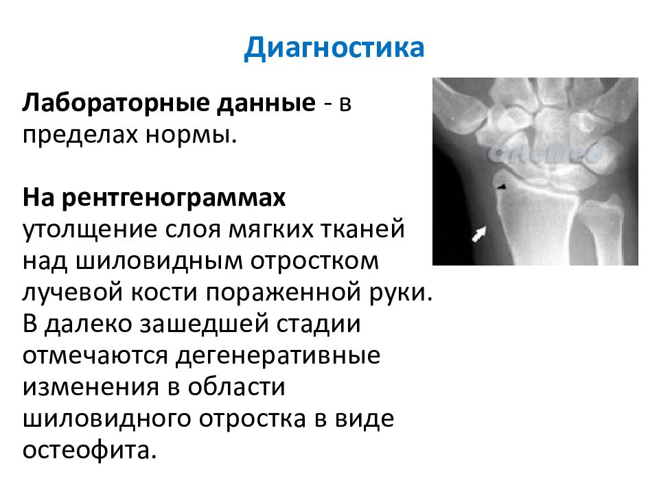 Болезнь кервена. Теносиновит шиловидного отростка. Теносиновит шиловидного отростка лучевой кости синдром де Кервена. Шиловидный отросток лучевой кости де Кервена. Болезнь де Кервена рентген признаки.